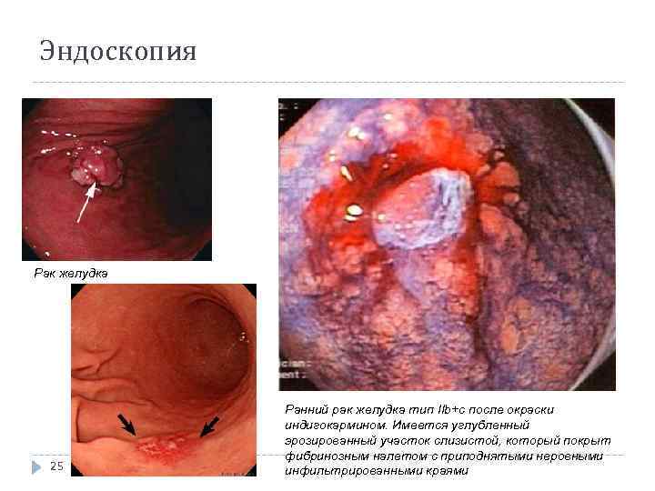 Эндоскопия Рак желудка 25 Ранний рак желудка тип IIb+с после окраски индигокармином. Имеется углубленный
