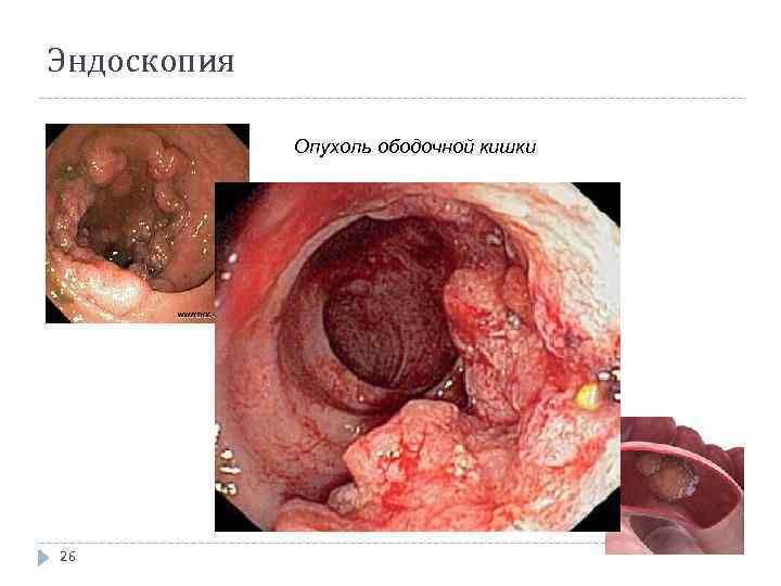 Эндоскопия Опухоль ободочной кишки 26 