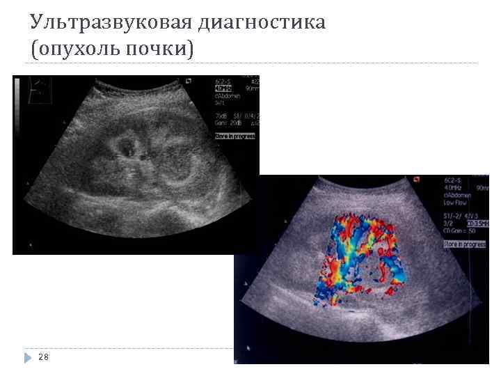 Ультразвуковая диагностика (опухоль почки) 28 