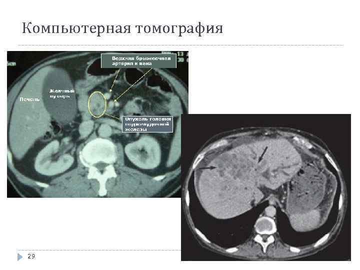 Компьютерная томография Опухолевые узлы 29 