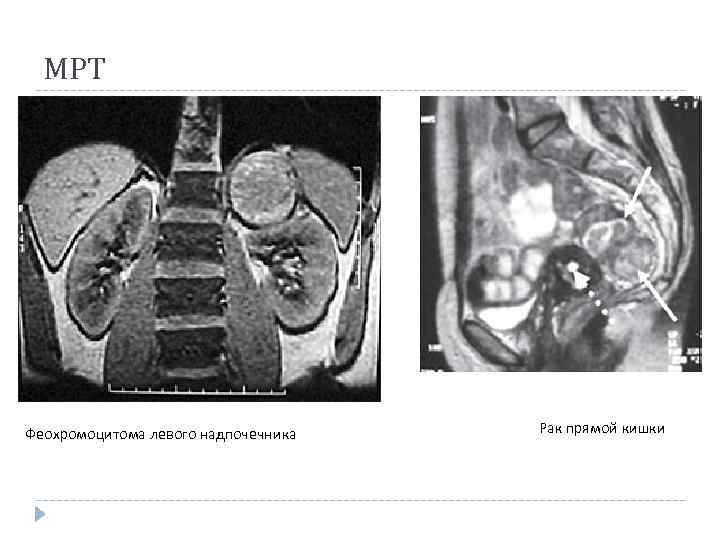 МРТ Феохромоцитома левого надпочечника Рак прямой кишки 