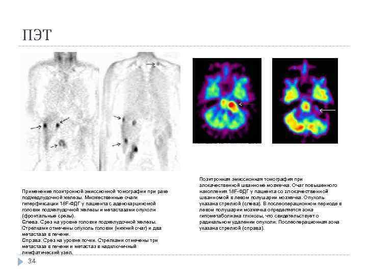 ПЭТ Применение позитронной эмиссионной томографии при раке поджедлудочной железы. Множественные очаги гиперфиксации 18 F-ФДГ