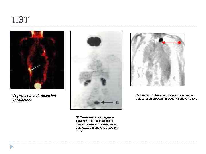 ПЭТ Результат ПЭТ-исследования. Выявление рецидивной опухоли верхушки левого легкого Опухоль толстой кишки без метастазов