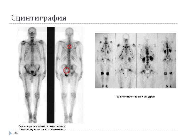 Сцинтиграфия Паранеопластический синдром Сцинтиграфия скелета (метастазы в седалищную кость и позвоночник) 36 