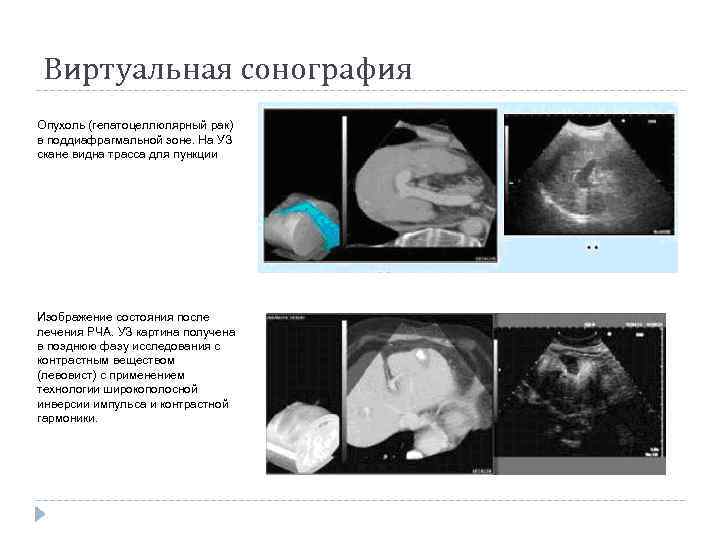 Виртуальная сонография Опухоль (гепатоцеллюлярный рак) в поддиафрагмальной зоне. На УЗ скане видна трасса для
