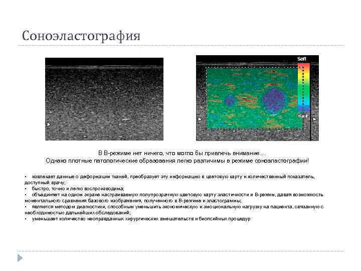 Соноэластография В В-режиме нет ничего, что могло бы привлечь внимание… Однако плотные патологические образования