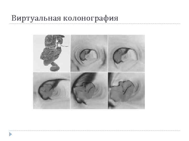 Виртуальная колонография 