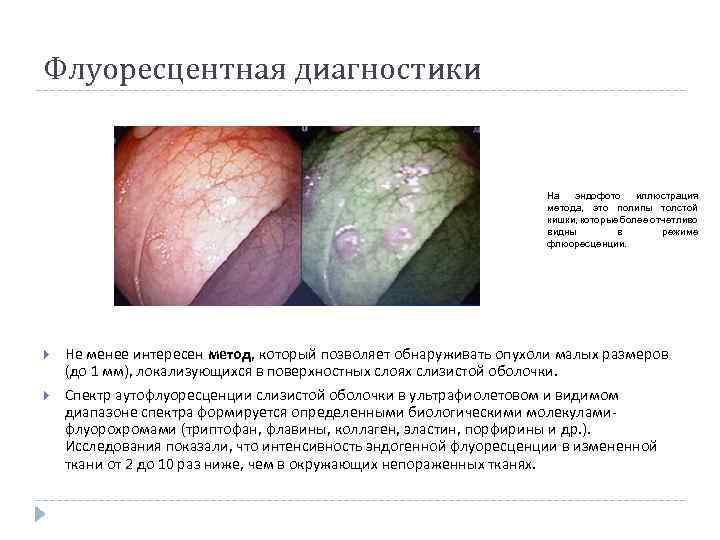 Флуоресцентная диагностики На эндофото иллюстрация метода, это полипы толстой кишки, которые более отчетливо видны