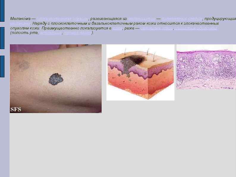 Мелано ма — злокачественная опухоль, развивающаяся из меланоцитов — пигментных клеток, продуцирующих меланины. Наряду