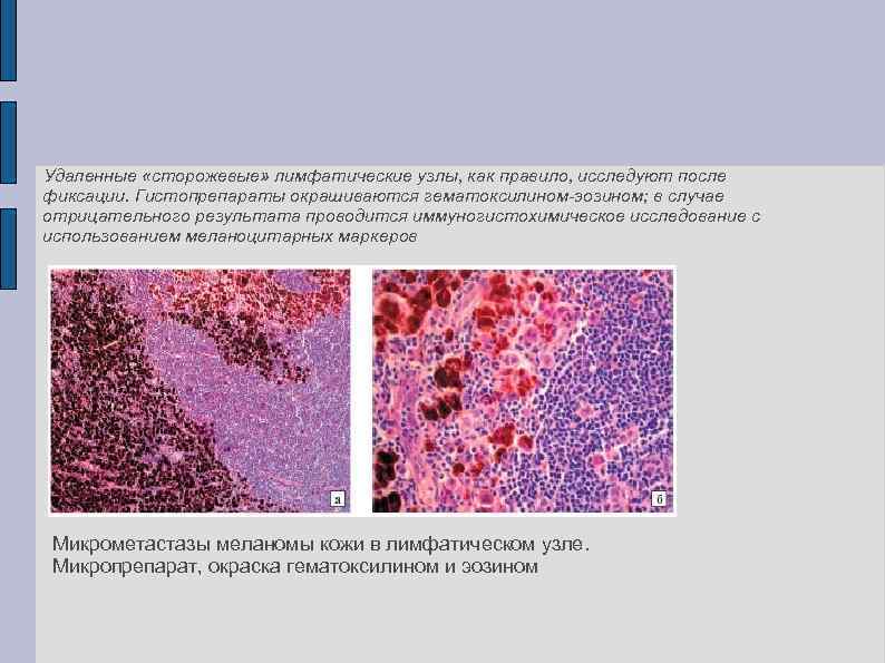  Удаленные «сторожевые» лимфатические узлы, как правило, исследуют после фиксации. Гистопрепараты окрашиваются гематоксилином-эозином; в