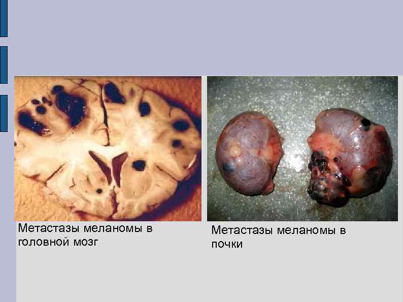 Метастазы меланомы в головной мозг Метастазы меланомы в почки 