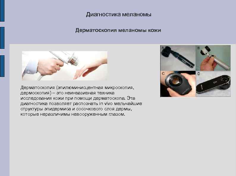 Диагностика меланомы Дерматоскопия меланомы кожи Дерматоскопия (эпилюминисцентная микроскопия, дермоскопия) – это неинвазивная техника исследования