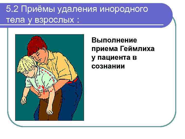 5. 2 Приёмы удаления инородного тела у взрослых : Выполнение приема Геймлиха у пациента