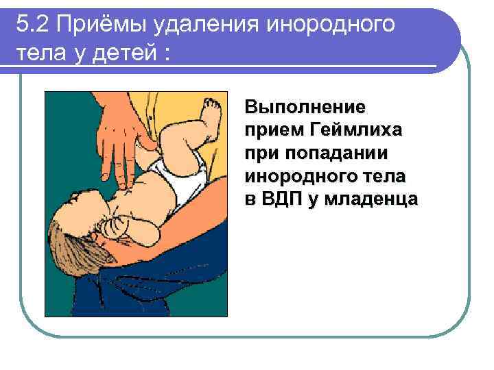 5. 2 Приёмы удаления инородного тела у детей : Выполнение прием Геймлиха при попадании