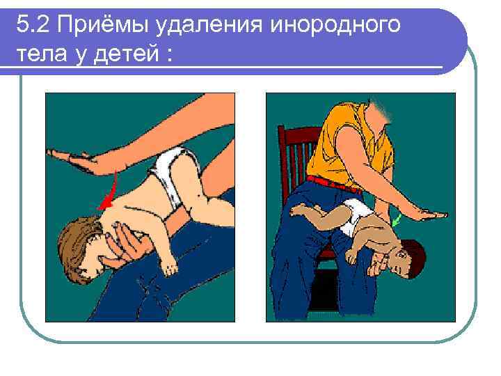 5. 2 Приёмы удаления инородного тела у детей : 