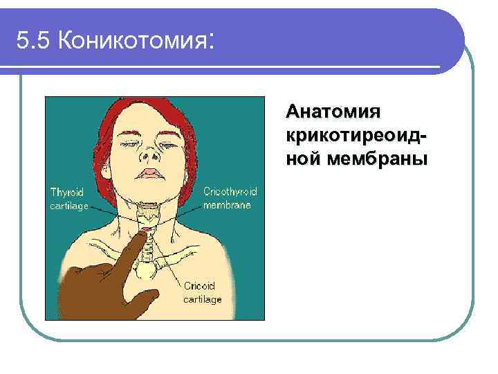 5. 5 Коникотомия: Анатомия крикотиреоидной мембраны 