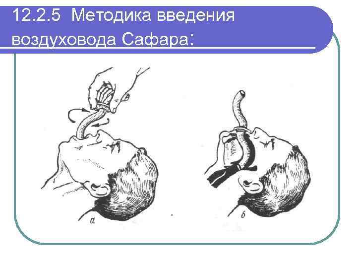 12. 2. 5 Методика введения воздуховода Сафара: 