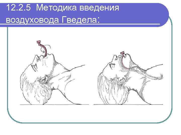 12. 2. 5 Методика введения воздуховода Гведела: 