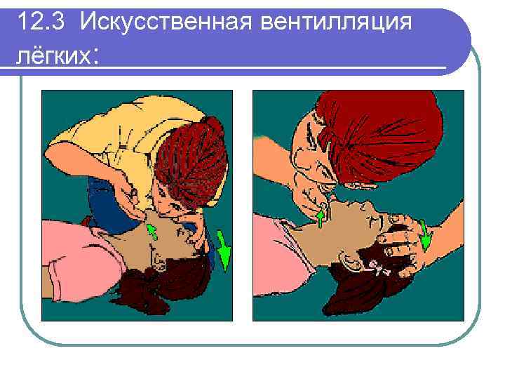 12. 3 Искусственная вентилляция лёгких: 