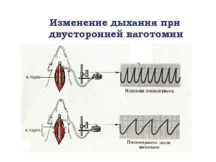 Изменение дыхания при двусторонней ваготомии 