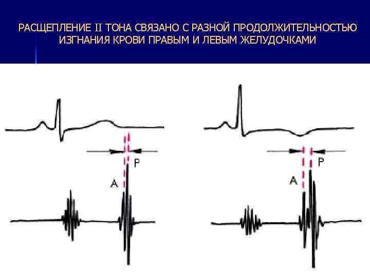 РАСЩЕПЛЕНИЕ II ТОНА СВЯЗАНО С РАЗНОЙ ПРОДОЛЖИТЕЛЬНОСТЬЮ ИЗГНАНИЯ КРОВИ ПРАВЫМ И ЛЕВЫМ ЖЕЛУДОЧКАМИ 