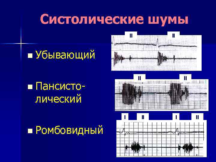 Систолические шумы II II n Убывающий II n Пансисто- II лический I n Ромбовидный