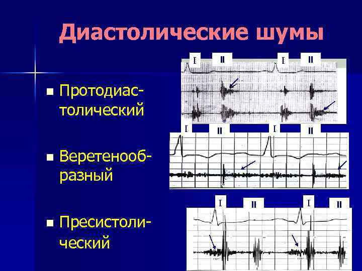 Диастолические шумы I n I II II II Веретенообразный I n I Протодиастолический I