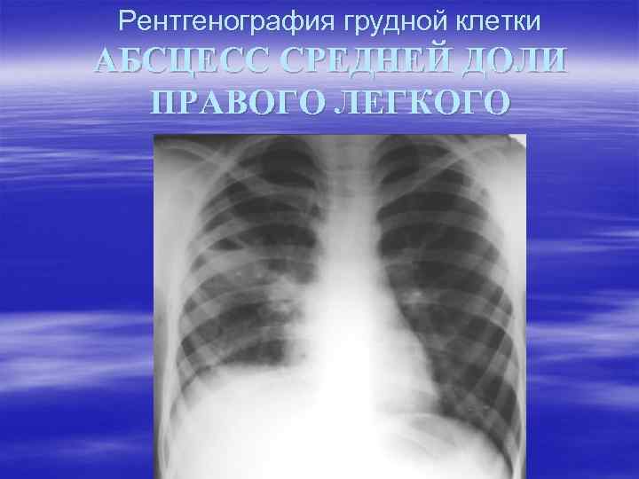 Рентгенография грудной клетки АБСЦЕСС СРЕДНЕЙ ДОЛИ ПРАВОГО ЛЕГКОГО 