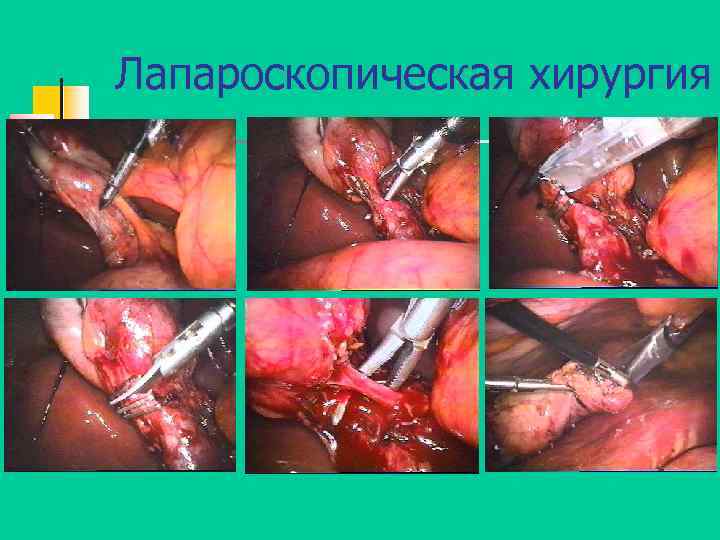 Лапароскопическая хирургия 