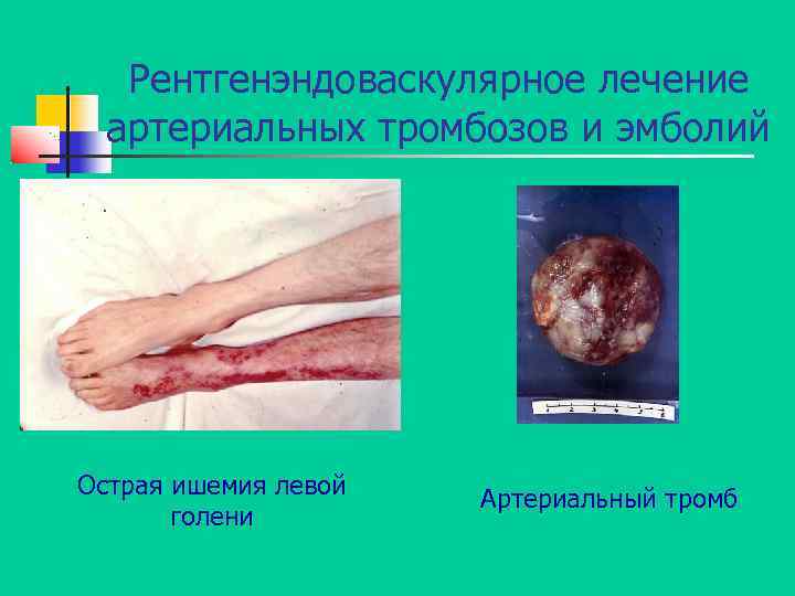 Рентгенэндоваскулярное лечение артериальных тромбозов и эмболий Острая ишемия левой голени Артериальный тромб 