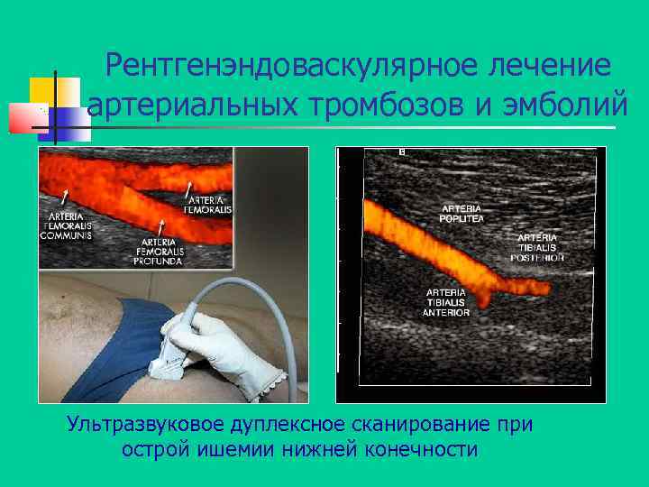 Рентгенэндоваскулярное лечение артериальных тромбозов и эмболий Ультразвуковое дуплексное сканирование при острой ишемии нижней конечности