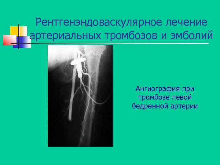 Рентгенэндоваскулярное лечение артериальных тромбозов и эмболий Ангиография при тромбозе левой бедренной артерии 