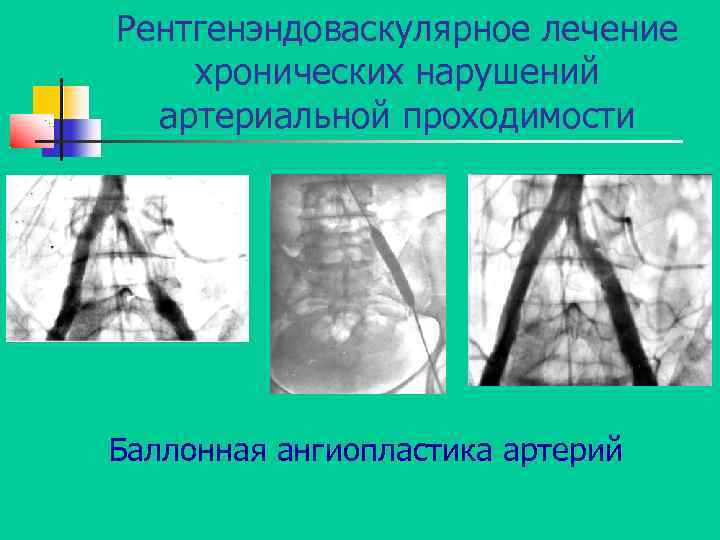 Рентгенэндоваскулярное лечение хронических нарушений артериальной проходимости Баллонная ангиопластика артерий 