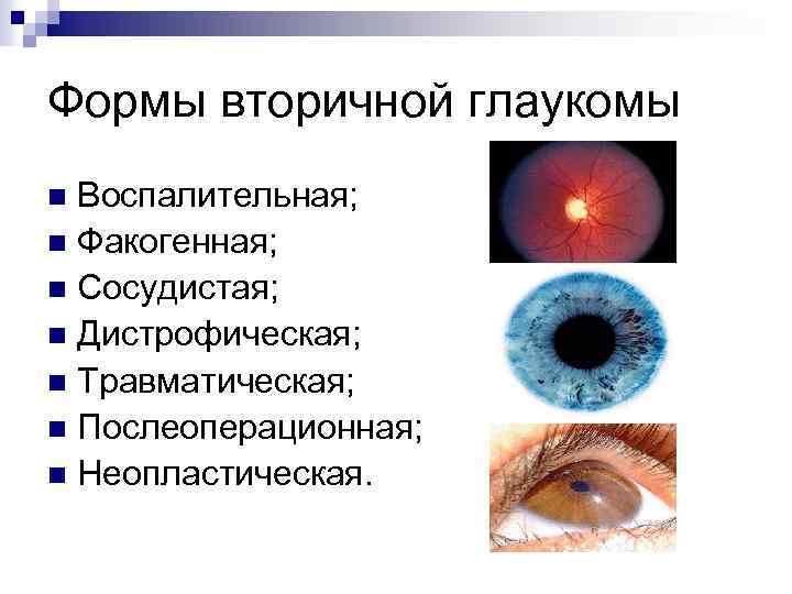 Классификация глаукомы. Вторичной открытоугольной глаукомы.. Постувеальная вторичная глаукома. Причины первичной глаукомы. Дистрофическая вторичная глаукома.