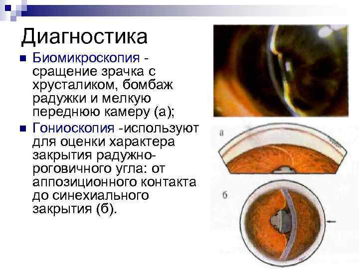 Диагностика n n Биомикроскопия сращение зрачка с хрусталиком, бомбаж радужки и мелкую переднюю камеру