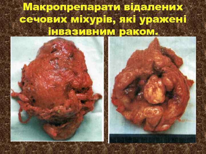 Макропрепарати відалених сечових міхурів, які уражені інвазивним раком. 
