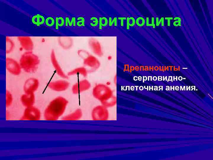 Форма эритроцита Дрепаноциты – серповидноклеточная анемия. 