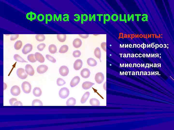 Форма эритроцита Дакриоциты: • миелофиброз; • талассемия; • миелоидная метаплазия. 