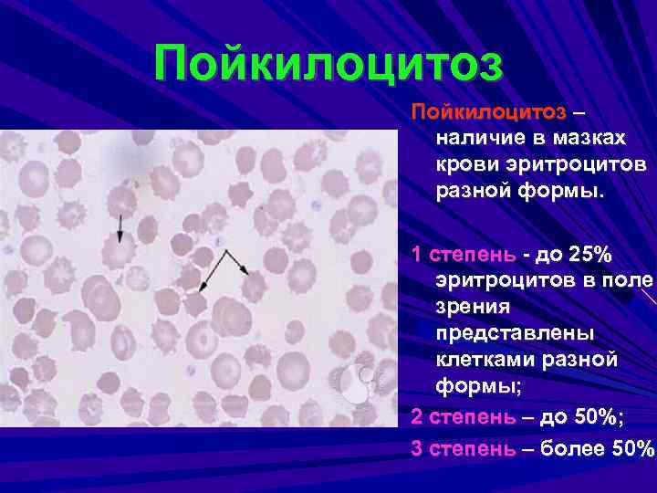 Пойкилоцитоз – наличие в мазках крови эритроцитов разной формы. 1 степень - до 25%