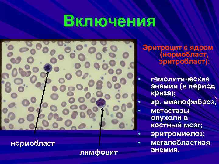 Включения Эритроцит с ядром (нормобласт, эритробласт): • • • нормобласт лимфоцит гемолитические анемии (в