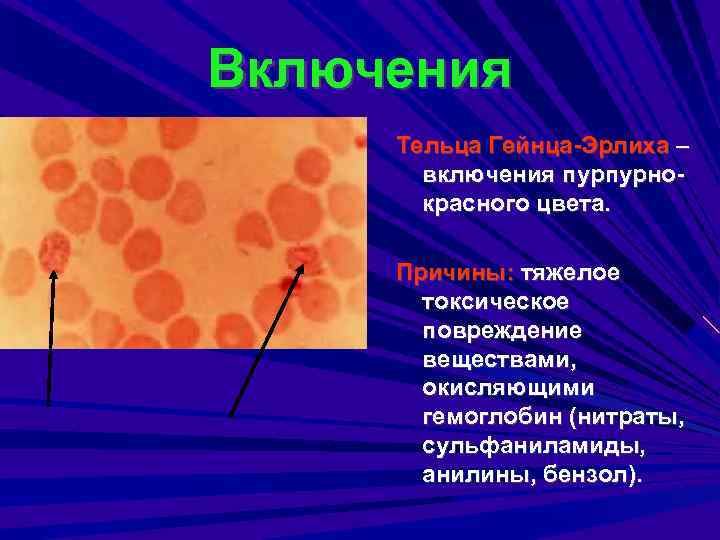 Включения Тельца Гейнца-Эрлиха – включения пурпурнокрасного цвета. Причины: тяжелое токсическое повреждение веществами, окисляющими гемоглобин