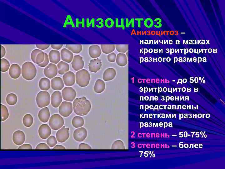 Анизоцитоз – Анизоцитоз наличие в мазках крови эритроцитов разного размера 1 степень - до