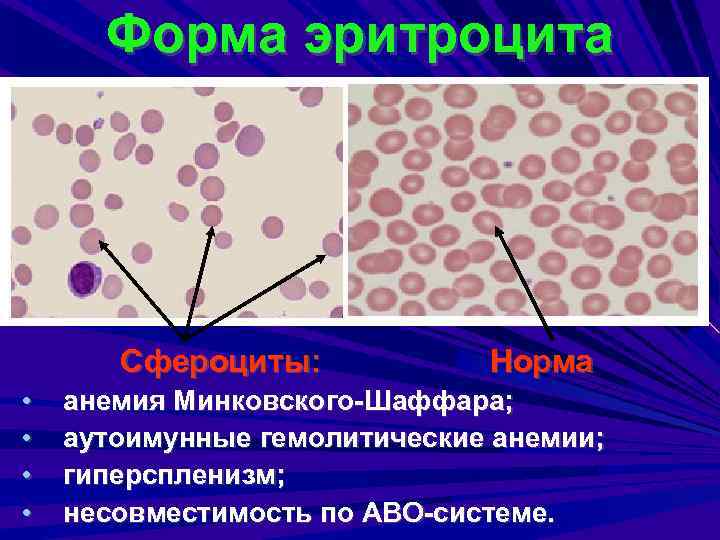 Форма эритроцита Сфероциты: • • Норма анемия Минковского-Шаффара; аутоимунные гемолитические анемии; гиперспленизм; несовместимость по