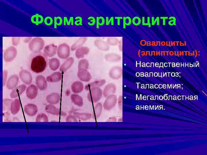 Форма эритроцита • • • Овалоциты (эллиптоциты): Наследственный овалоцитоз; Талассемия; Мегалобластная анемия. 