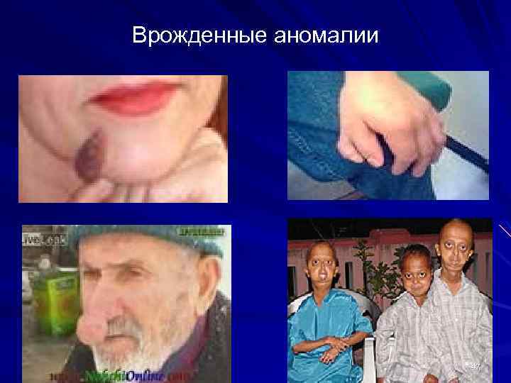 Врожденные аномалии 47 