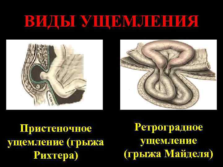 ВИДЫ УЩЕМЛЕНИЯ Пристеночное ущемление (грыжа Рихтера) Ретроградное ущемление (грыжа Майделя) 