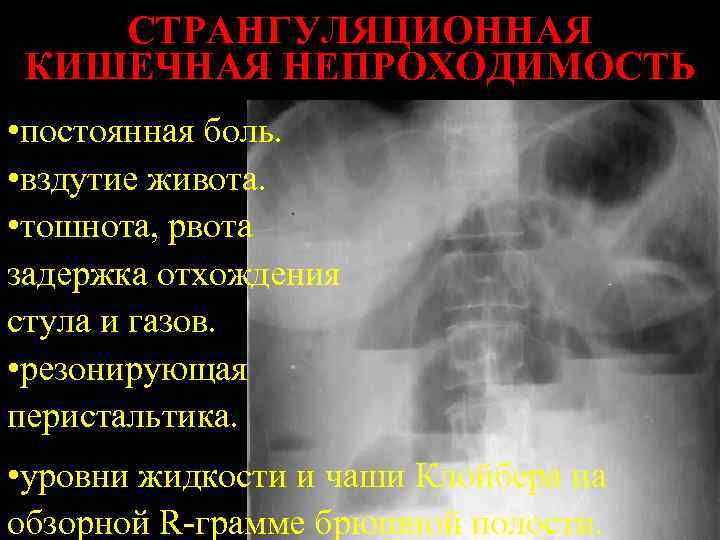 СТРАНГУЛЯЦИОННАЯ КИШЕЧНАЯ НЕПРОХОДИМОСТЬ • постоянная боль. • вздутие живота. • тошнота, рвота задержка отхождения