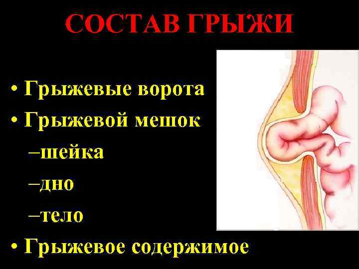 СОСТАВ ГРЫЖИ • Грыжевые ворота • Грыжевой мешок –шейка –дно –тело • Грыжевое содержимое