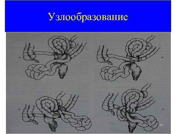 Кишечная непроходимость карта смп