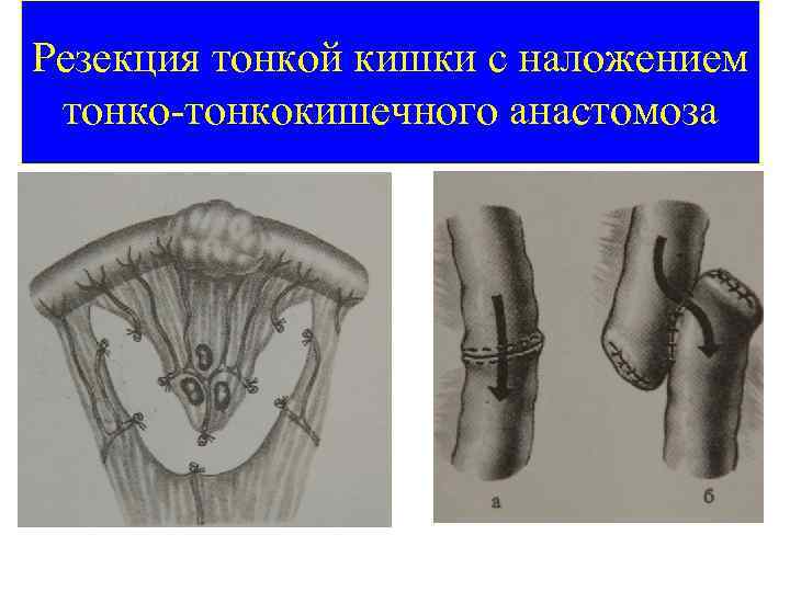 Резекция тонкой кишки с наложением тонко-тонкокишечного анастомоза 39 
